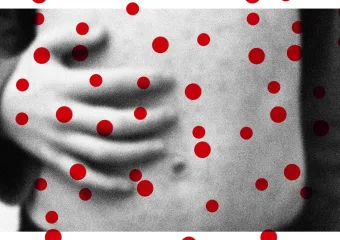 Slučajevi ospica rastu. Ostale bolesti koje se mogu spriječiti mogle bi slijediti