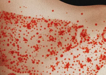 Znanstvenici smatraju da će ospice vjerojatno postati endemske u SAD -u tijekom sljedećih 20 godina