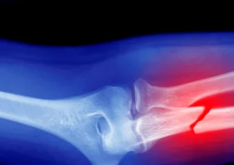 Mikroplastika bi mogla slabiti vaše kosti, sugeriraju istraživanje