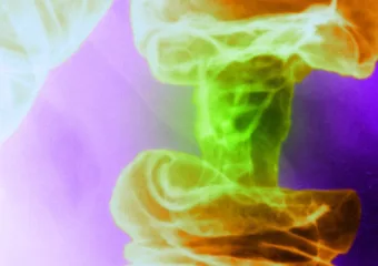 Novo svjetlosno liječenje raka ubija tumorske stanice i štedi zdrave